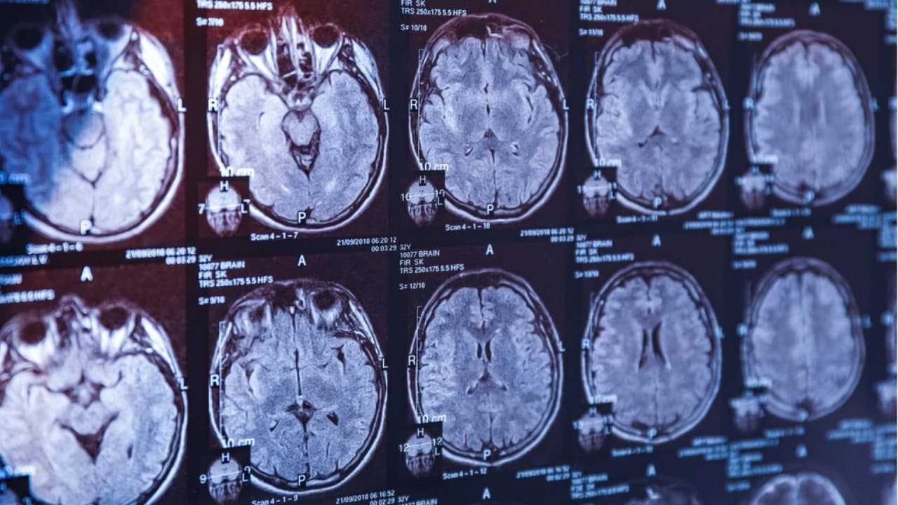 Her Unutkanlık Alzheimer Belirtisi Mi? Uzman İsimden Kritik Uyarı