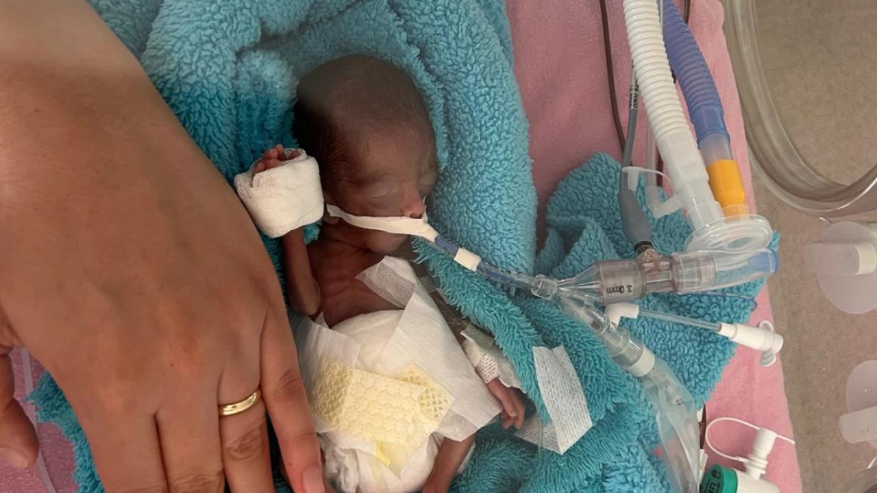 Aydın'da 22 Haftalık Doğup 350 Gram Kalan Rüzgar Bebek 240 Gün Sonra Sağlığına Kavuştu