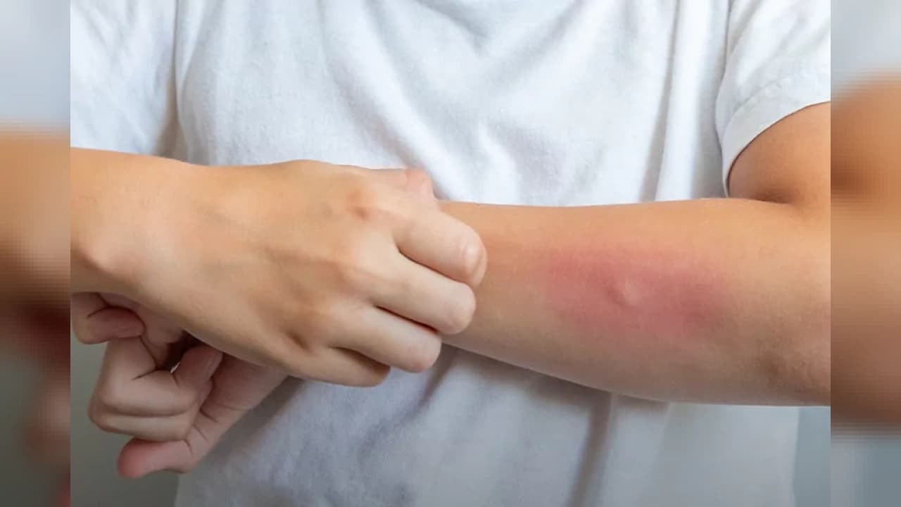 Uzmanından uyarı: Egzama sosyal yaşamı ve psikolojiyi etkiliyor