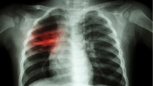 CDC Rusya'daki Şüpheli Zatürre Ölümünü Takibe Aldı