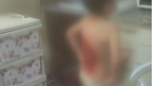 Arnavutköy'de 12 yaşındaki çocuğun sırtına kolonya dökülüp ateşe verildi